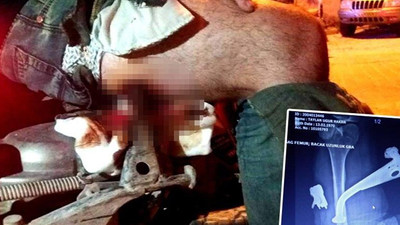 Bacağına saplanan motosiklet ayaklığı, ameliyatla çıkarıldı