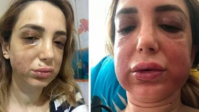 Estetik mağduru kadının yüzü tanınmaz hale geldi