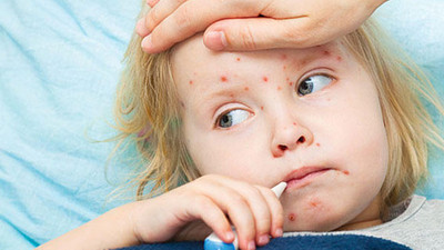 Kızamık salgını alarmı