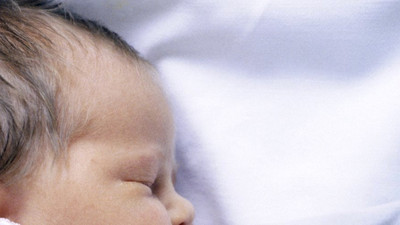 Mide ilacı yerine saçkıran ilacı verilen bebeklerde 'kurt adam' belirtileri görüldü