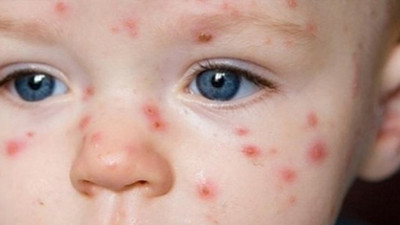 ABD'de kızamık salgını sona erdi