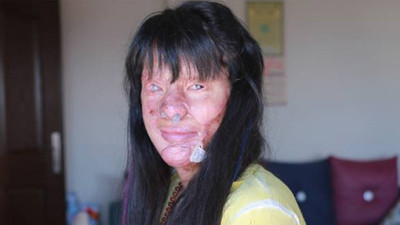 Asitli saldırıya uğrayan Berfin Özek'ten 25 Kasım mesajı