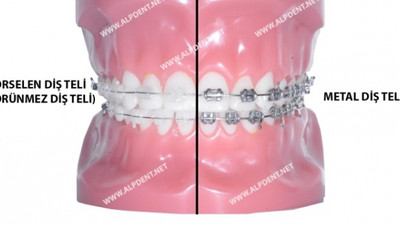 Ortodonti Tedavisinde Doktor Seçimi