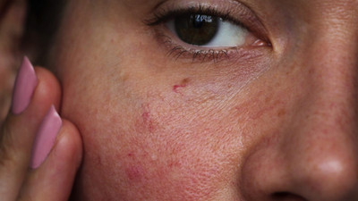 Karantina günleri cildi olumsuz etkiliyor