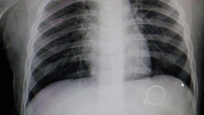 1.5 yaşındaki bebek annesinin tek taşını yuttu