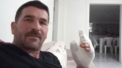 Köpekleri korkutmak için yaktığı torpil elinde patladı