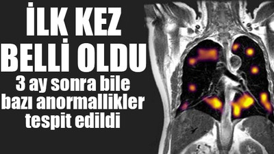 Koronavirüsün akciğerleri nasıl etkilediği ortaya çıktı