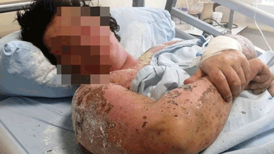 Yanlış antibiyotik kullanımı hayatını zindana çevirdi