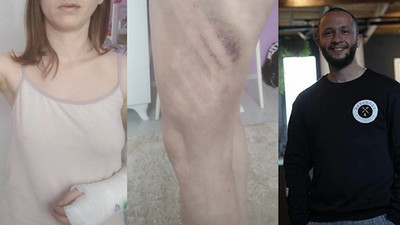 Kız arkadaşını beyzbol sopasıyla darp eden erkek tutuklandı