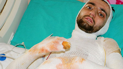 Sobaya benzin dökünce yandı: Cehennemi yaşadım