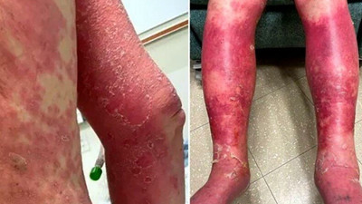 Tek doz aşıda korkutan yan etki