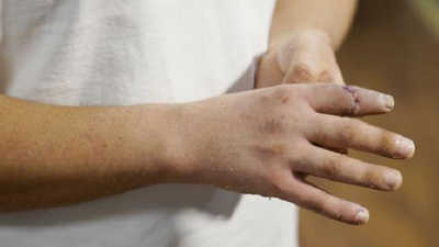 Malta'da kopan parmağını sırt çantasında Türkiye'ye taşıdı ve literatüre girdi