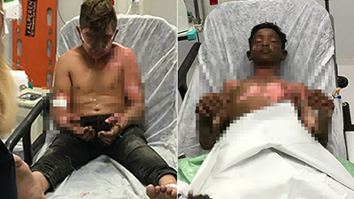 Ateşe tiner döken 2 çocuk yandı