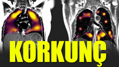 Koronavirüs geçirenlerin akciğerlerinden çıkanlar şoke etti