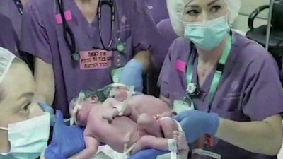 Milyonda bir gerçekleşen ameliyat...