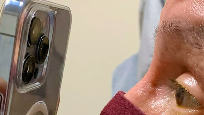 ABD'li doktor, göz tedavisi için iPhone kullandı 