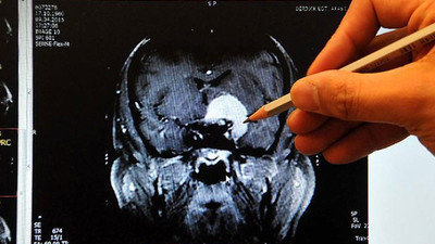 Türk profesör koronavirüsün beyne etkisini yazdı: Küçültüyor