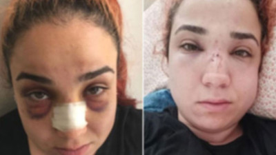 Patronu tarafından burnu kırılan çalışana hapis istemi: Suçu kendisini korumaya çalışmak