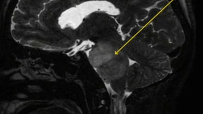 4 aydır durmadan hıçkırıyor! Nedenini uzmanlar açıkladı