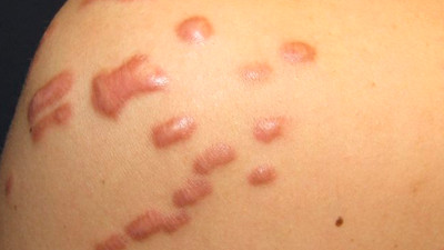 Estetik yaptırmak isteyenler dikkat! Uzmanı keloide karşı uyardı