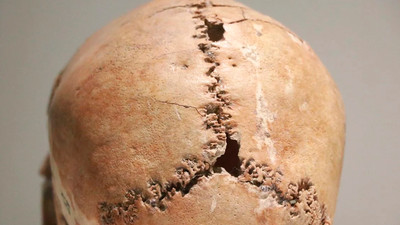 Kapadokya'ya açılan şehir şaşırtmaya devam ediyor! Dünyanın ilk beyin ameliyatı burada yapılmış