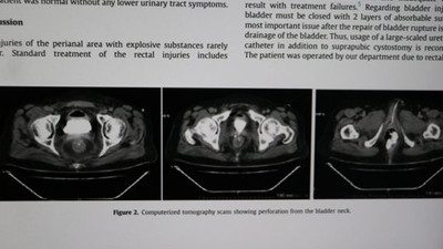 Makatında torpil patlattı, tıp literatürüne girdi