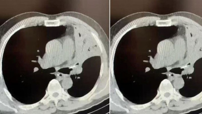 Öksürük şikayetiyle gitti, hastanede şok gerçekle yüzleşti