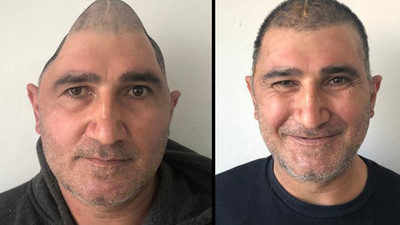 Doğum gününde kafatasının yüzde 83'ü Parçalanmıştı: 'Mucize adam' eski haline kavuştu