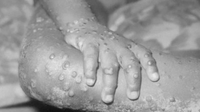 DSÖ açıkladı: Dünya çapında kaç maymun çiçeği vakası var? 