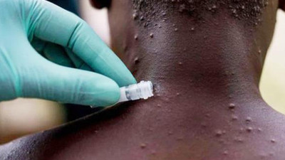 Maymun çiçeği virüsü hakkında bilinmesi gerekenler... En çok kime bulaşıyor? 