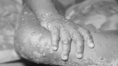 Sağlık Bakanlığı açıkladı... Türkiye'de 'maymun çiçeği' vakası görüldü mü? 