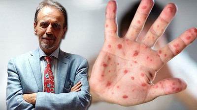 Prof. Dr. Mehmet Ceyhan'dan maymun çiçeği virüsüne karşı çarpıcı uyarı