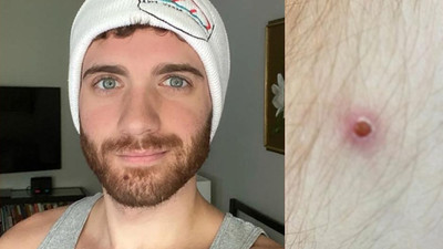 Maymun çiçeği hastalığına yakalanan Türk konuştu: Semptomları anlattı