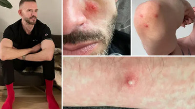 Maymun çiçeği hastası yaşadıklarını anlattı: Acıdan çığlık atıyordum