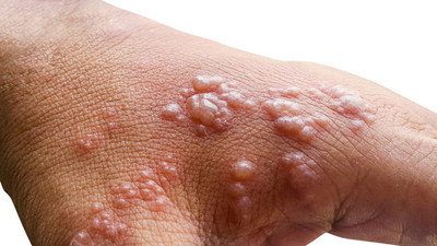 Sağlık Bakanlığı 'maymun çiçeği' için rehber paylaştı