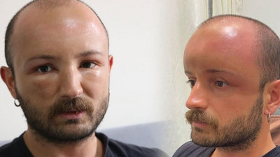 2 gün üst üste plaja gitti; aynaya bakınca şoke oldu