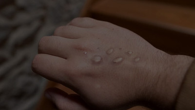 Türkiye'de maymun çiçeğine yakalananların sayısı 11'e yükseldi 