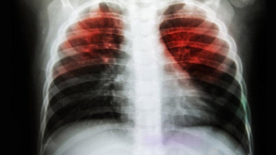 Tüberküloz ölümleri yeniden artıyor
