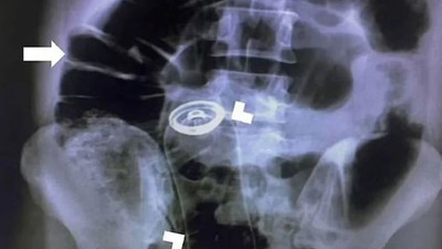 Tıp literatürüne girecek bir olay yaşandı: Röntgende kalçasından deodorant kutusu çıktı
