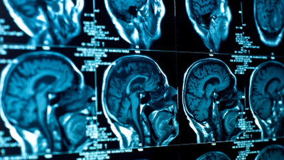 Yapay zeka sistemi ile beyin tümörü tespit edildi: Hastanın hayatı kurtuldu