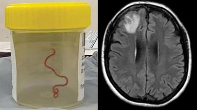 Dünyada bir ilk: Hastanın beyninden 8 santimetrelik canlı solucan çıktı