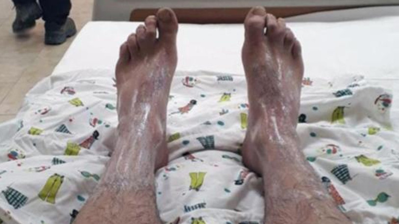 Ayağına sülfürik asit dökülen işçi işten atıldı