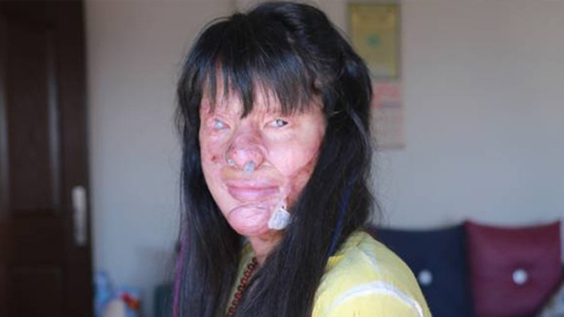 Asitli saldırıya uğrayan Berfin Özek'ten 25 Kasım mesajı