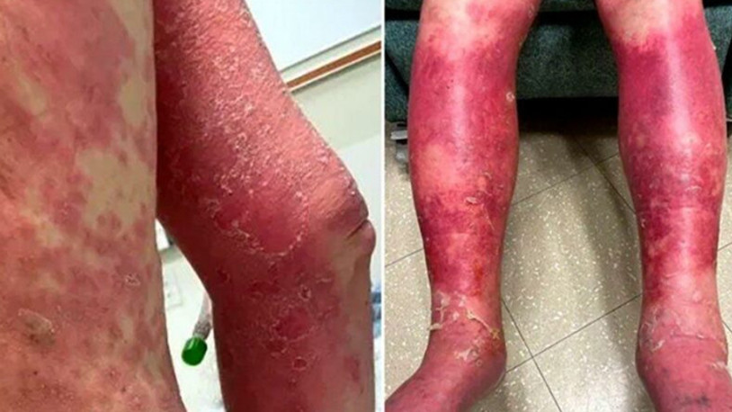 Tek doz aşıda korkutan yan etki