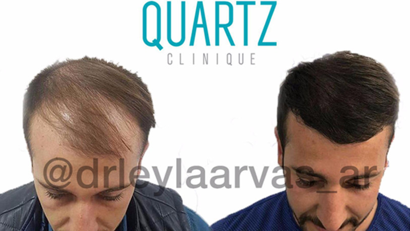 SAÇ EKİMİ İSTANBUL‘DA EN FAZLA YAPTIRILAN OPERASYONLARIN BAŞINDA GELİYOR