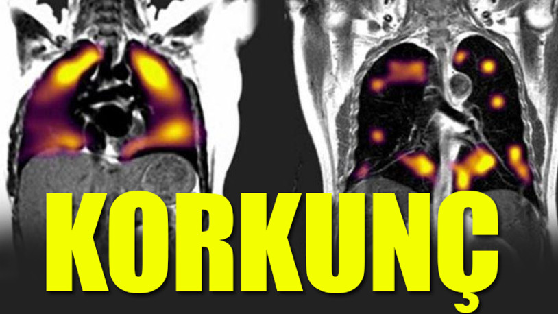 Koronavirüs geçirenlerin akciğerlerinden çıkanlar şoke etti