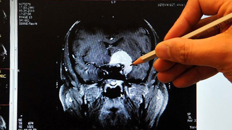 Türk profesör koronavirüsün beyne etkisini yazdı: Küçültüyor
