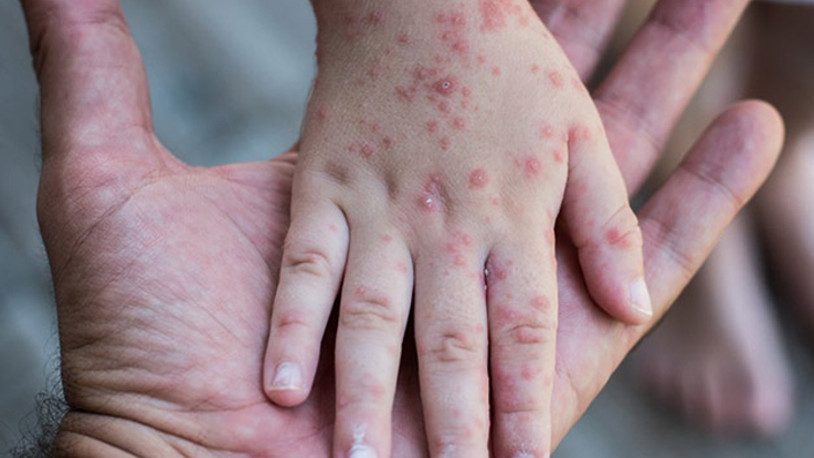 Koronavirüs etkisi: Kızamık vakalarında yüzde 80 artış