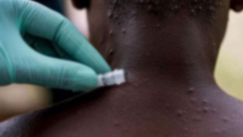 Bir ülkede daha maymun çiçeği vakası görüldü 