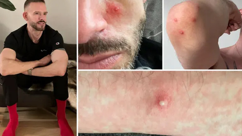 Maymun çiçeği hastası yaşadıklarını anlattı: Acıdan çığlık atıyordum